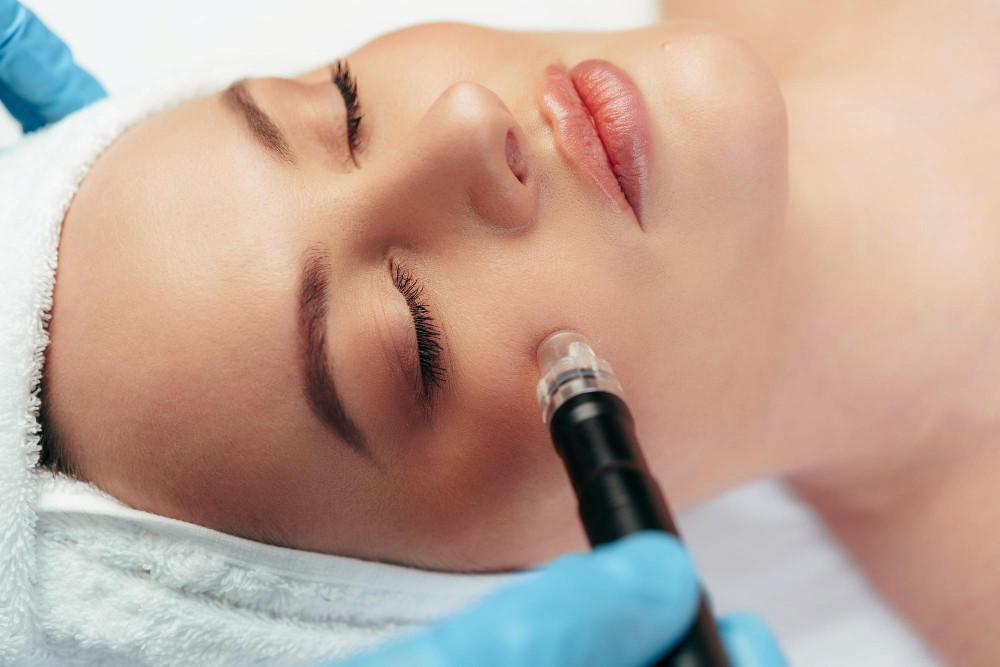 Micro Needling Face Treatment